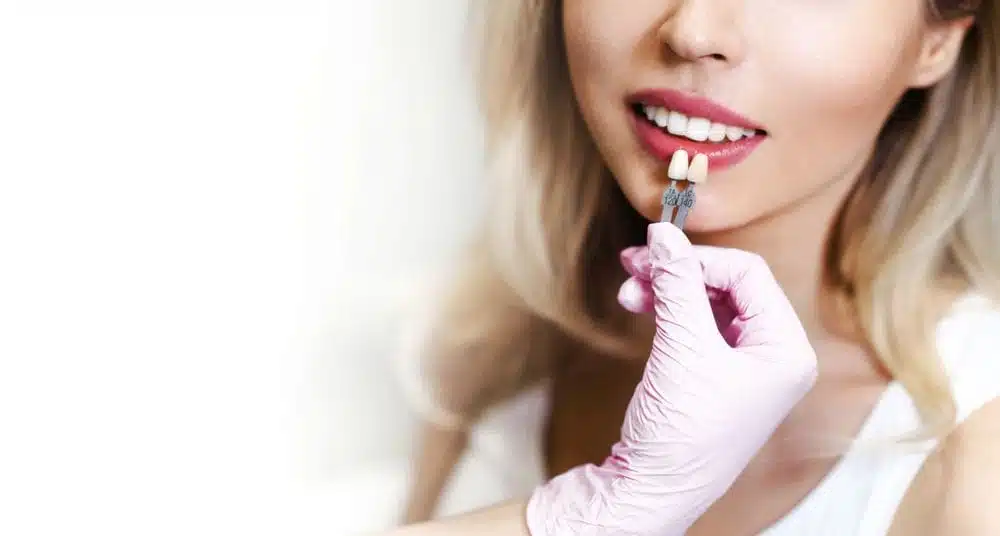 Veneers: Are They Right for You?