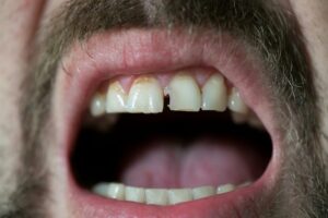 When to Treat a Chipped Tooth