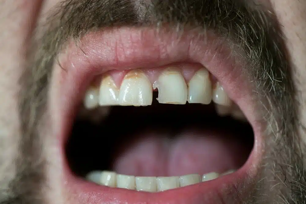 When to Treat a Chipped Tooth