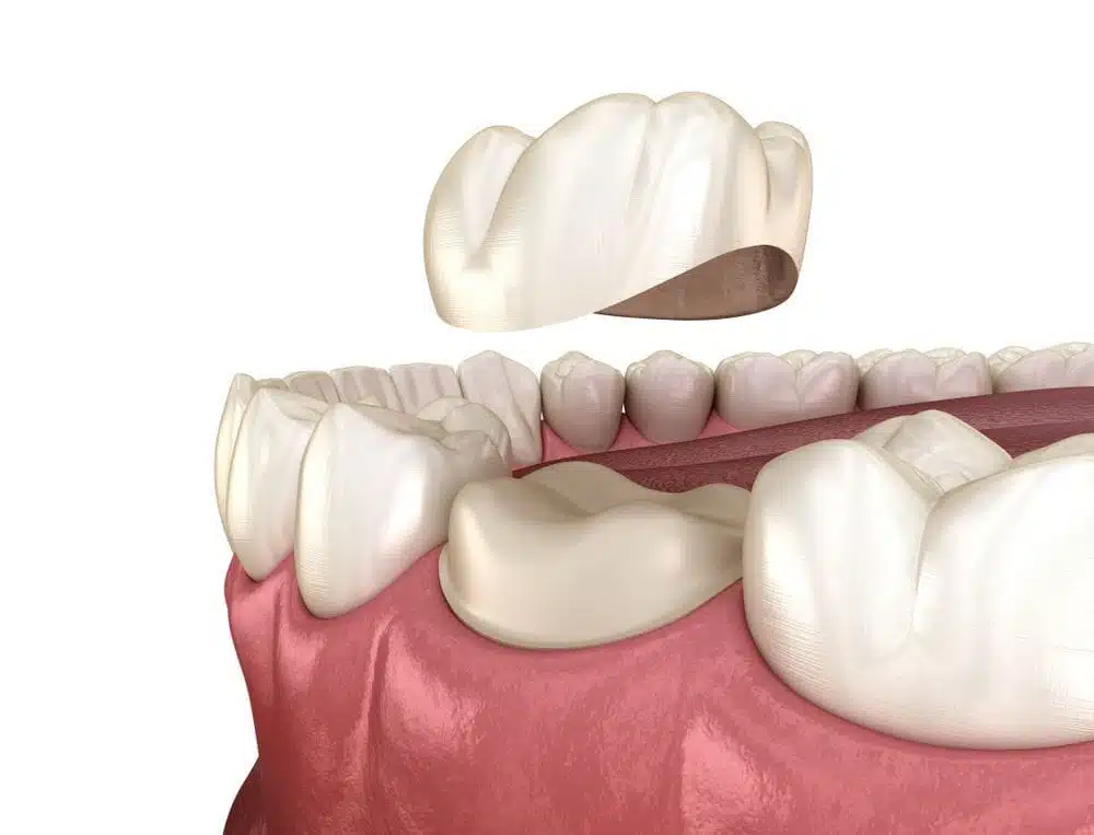 How Long Can a Tooth Go Without a Crown?