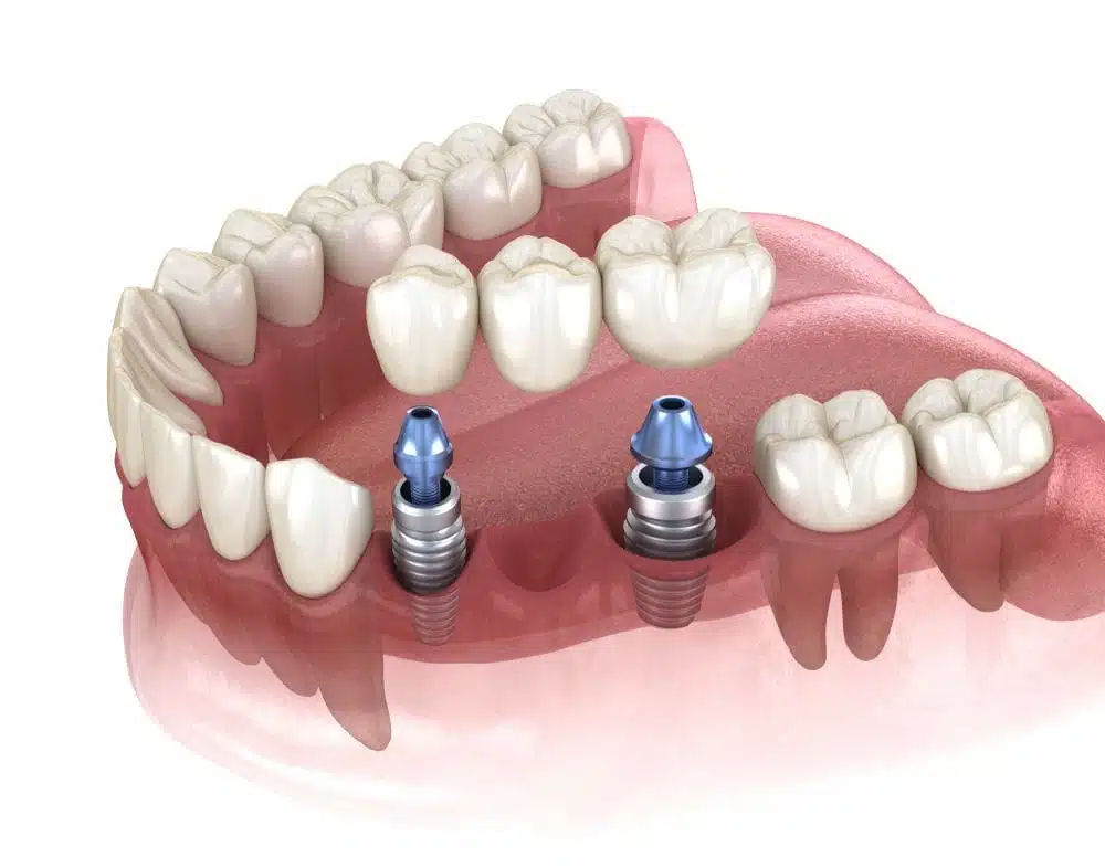 Understanding Bridges on Implants: