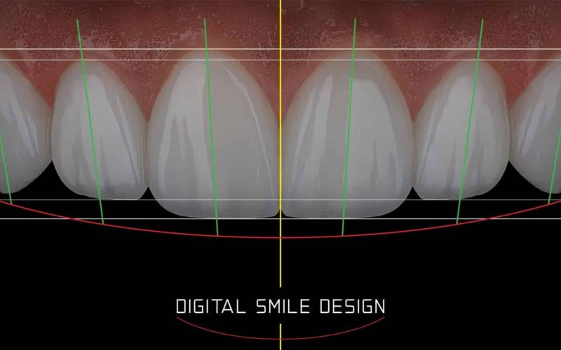 In,Aesthetic,Dentistry,,Digital,Smile,Design,Involves,Creating,An,Enhanced