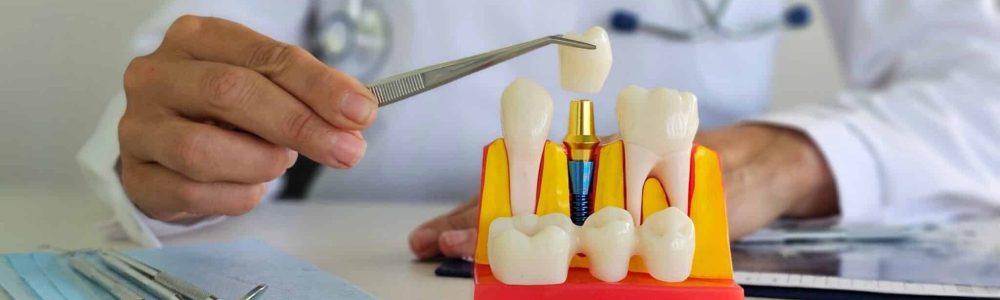 Doctor,Hold,Dental,Implant,,Artificial,Tooth,Roots,Into,Jaw,,Root